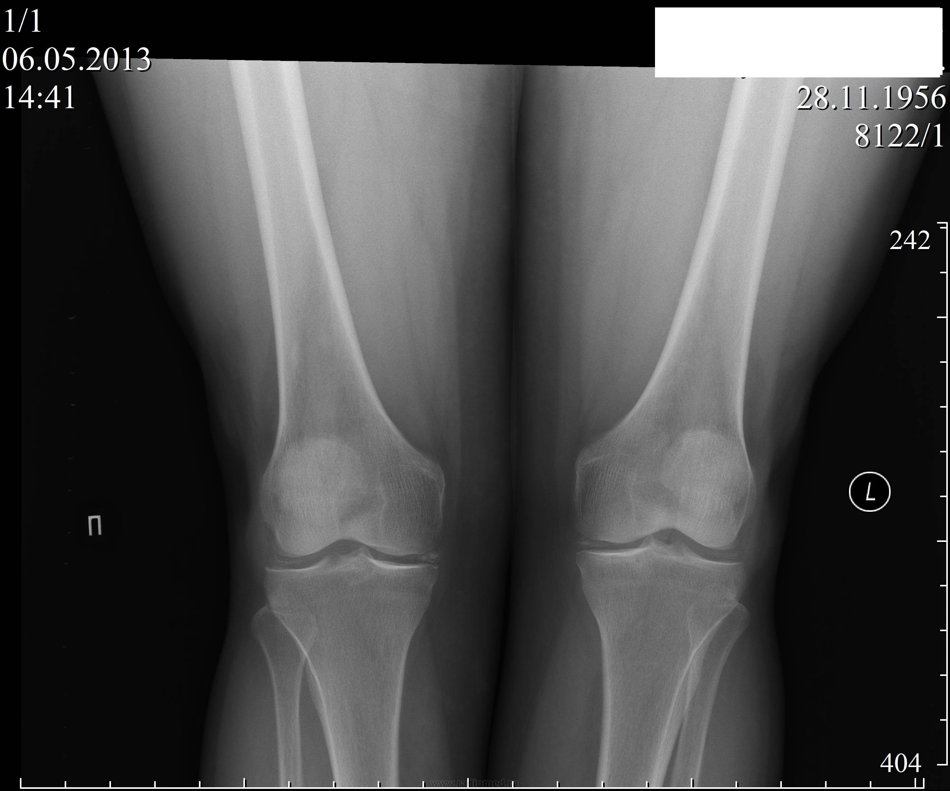 Рентген колена. Коленный сустав рентген норма. Рентгеновские снимки коленного сустава норма. Рентген нормального коленного сустава. Рентген снимок коленного сустава в норме.