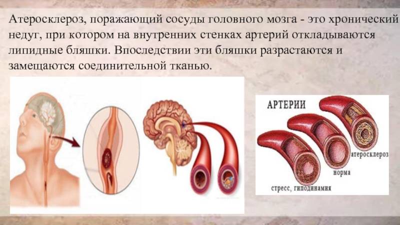 Атеросклероз сосудов головного мозга: симптомы и лечение