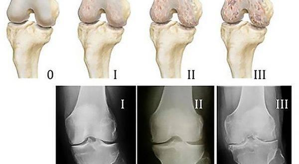 Болезнь кенига коленного сустава: лечение, операция, прогноз