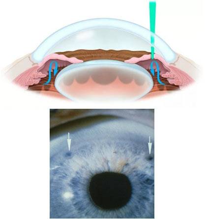 Лазерная базальная иридэктомия как эффективный метод лечения глаукомы