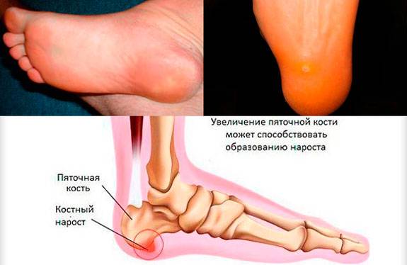 Почему болят пятки - что делать и как лечить: диагностика и профилактика болезней ног