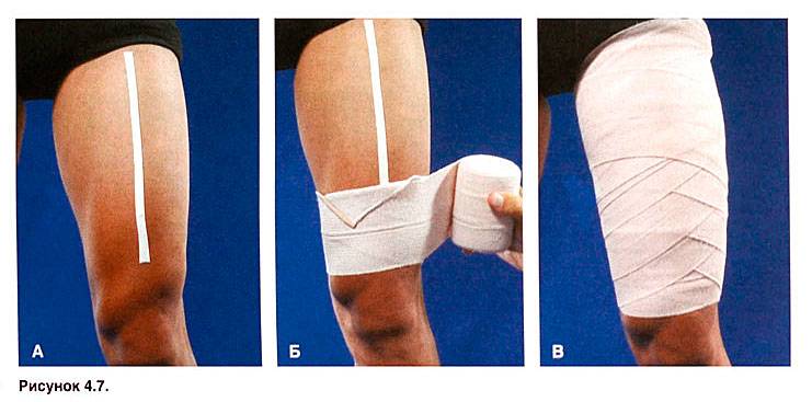 Лечение частичного разрыва мышц. Бинтование коленного сустава эластичным бинтом. Икроножная мышца бинтование. Бинтование бедра. Перевязка икроножной мышцы бинтом.