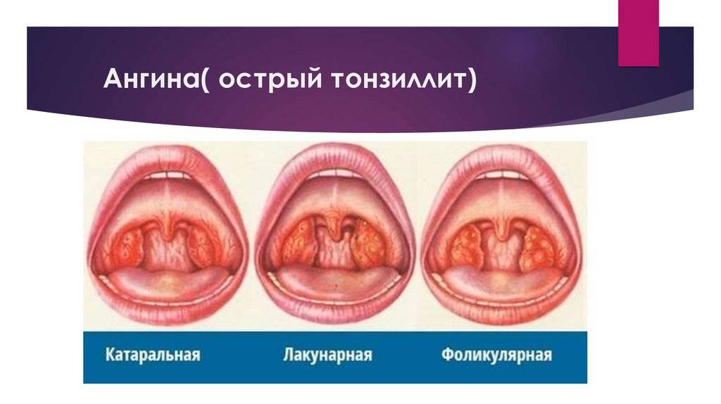 Стафилококковая ангина (тонзиллит): симптомы, признаки и лечение