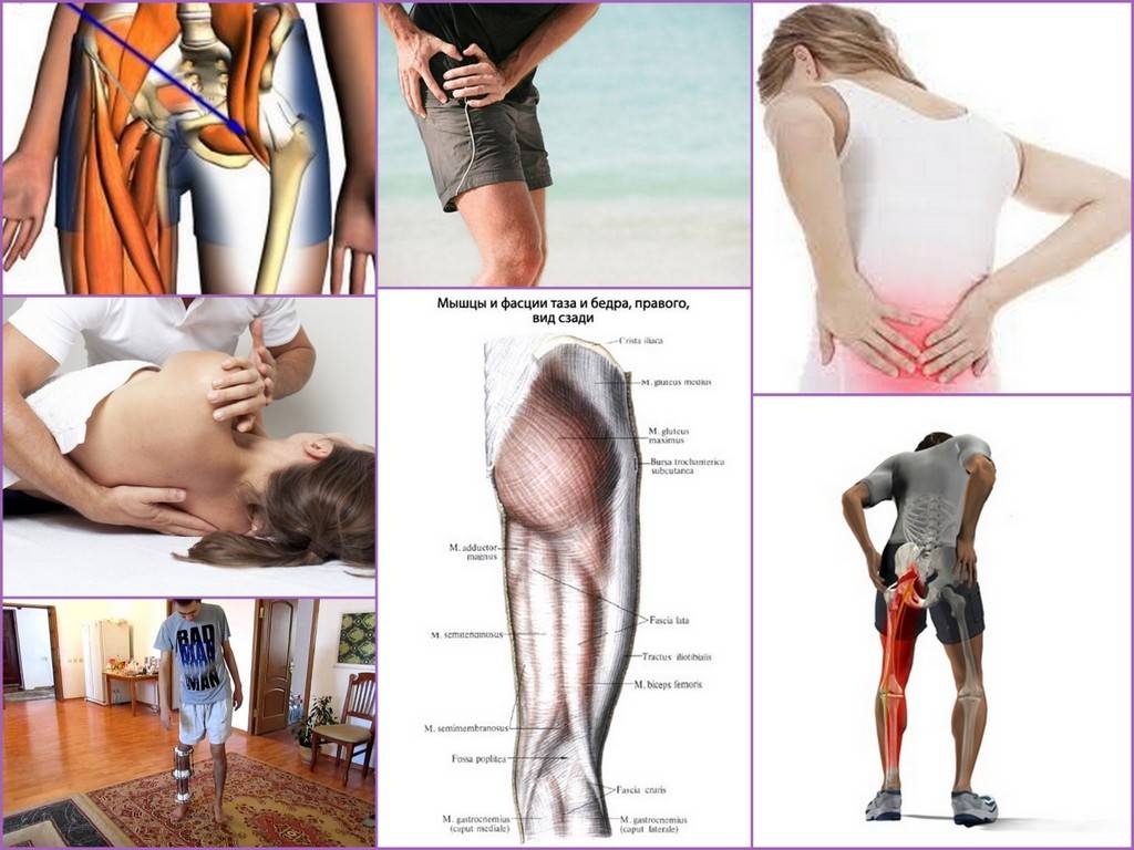 Как болит тазобедренный сустав симптомы у женщин. Атрофия мышц при коксартрозе тазобедренного сустава. Боли при коксартрозе тазобедренного. Бедренный сустав болит.
