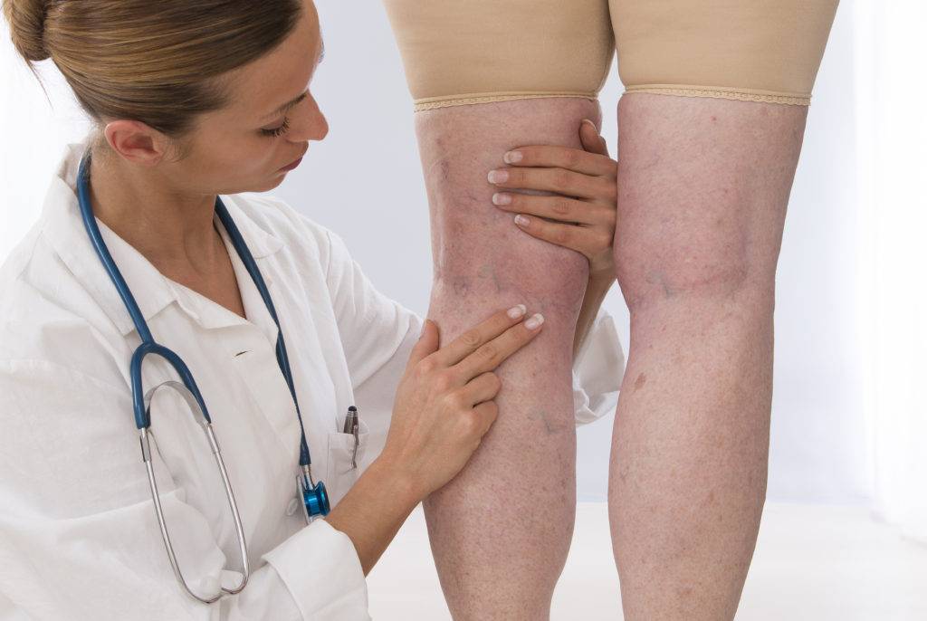 Тромбоз глубоких вен нижних конечностей - симптомы и лечение