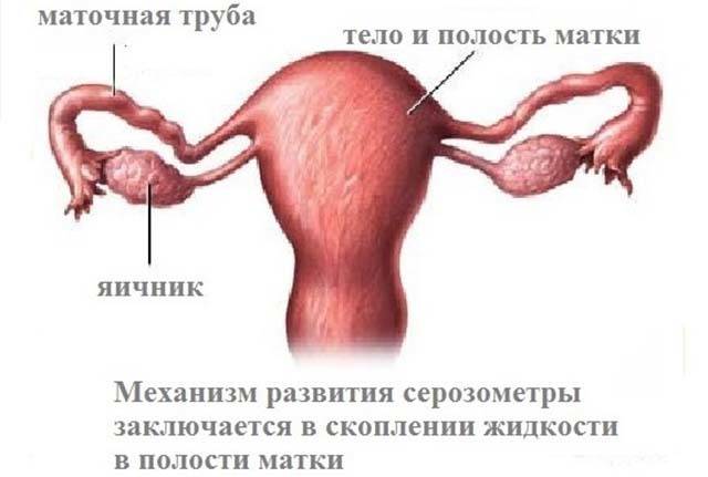 Выскабливание при менопаузе - лечение гиперплазии эндометрия