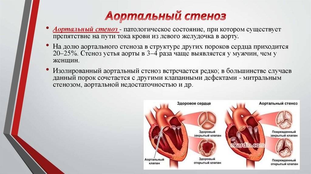 Митральная конфигурация сердца при митральном стенозе