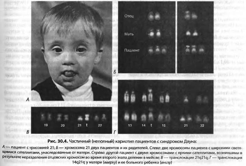Синдром патау (трисомия 13): первые симптомы у новорожденных, лечение и профилактика