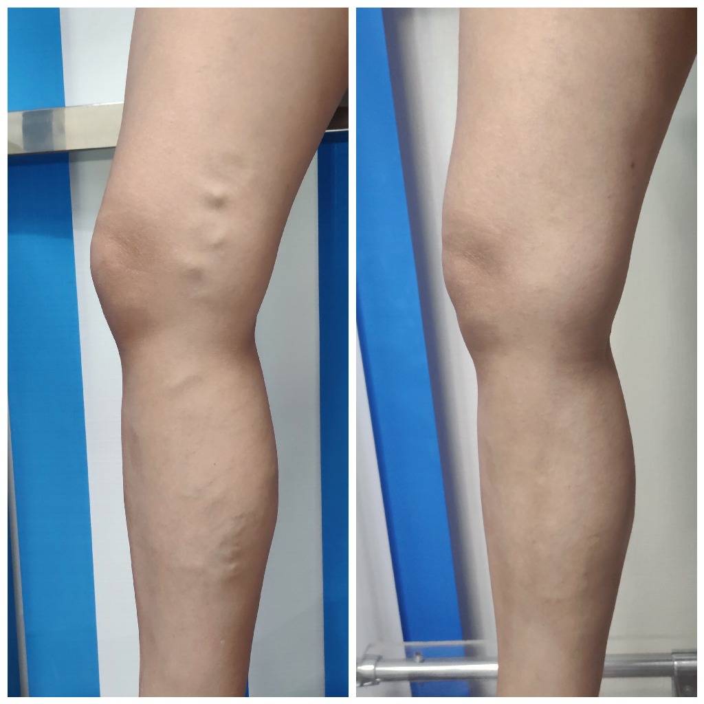 Варикоз, расширение вен на ногах лечение вен на ногах в клинике в москве