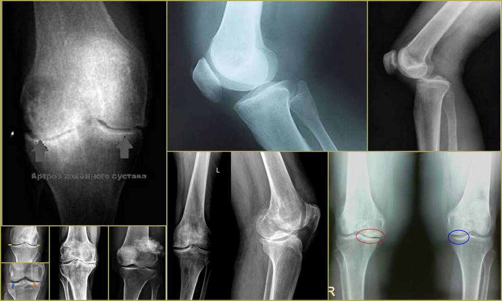 Болезнь кенига коленного сустава у детей спортсменов