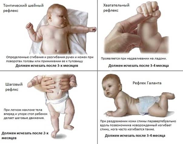 Гипотонус мышц у младенцев и его лечение у детей