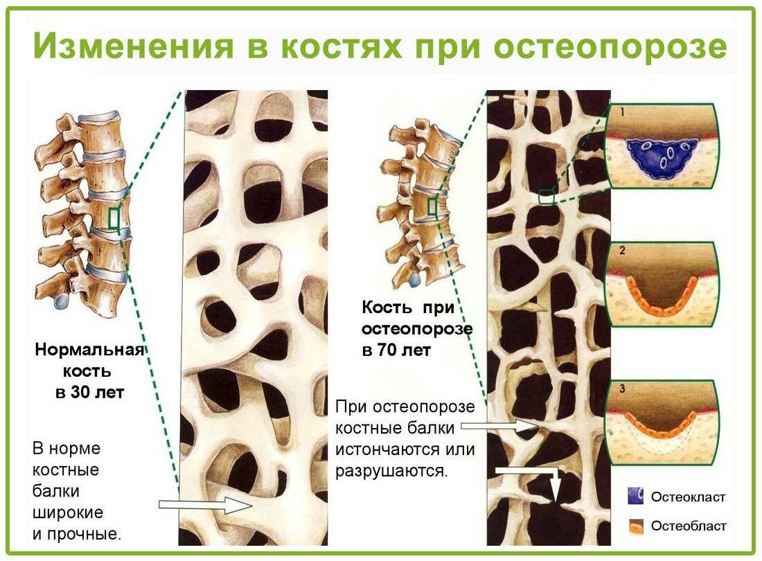 Структурные изменения костей. Диффузный сенильный остеопороз. Остеопороз 4 степени позвоночника. Костная ткань в норме и остеопороз. Нормальная кость и кость при остеопорозе.