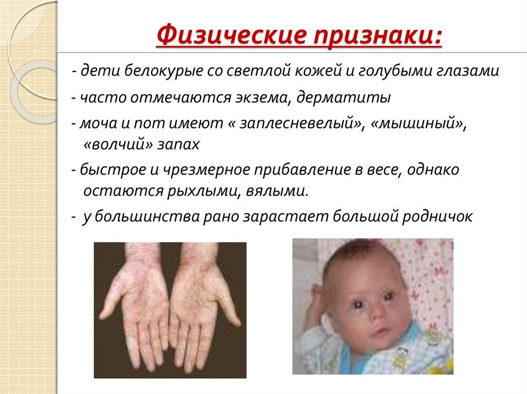 Умственная отсталость: ее степени, причины, признаки, лечение у детей