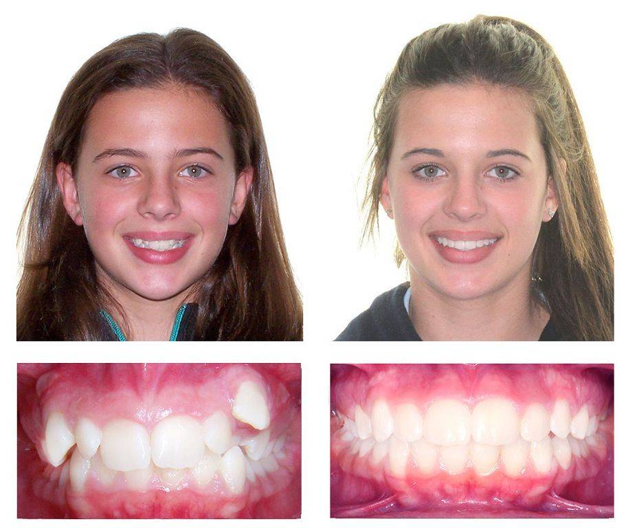 Зубы после брекетов - как выглядят после установки? фото до и после, отзывы