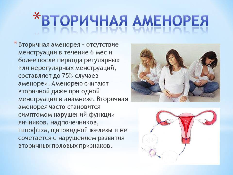 Аменорея у женщин: что это такое, первичная и вторичная, причины и лечение.