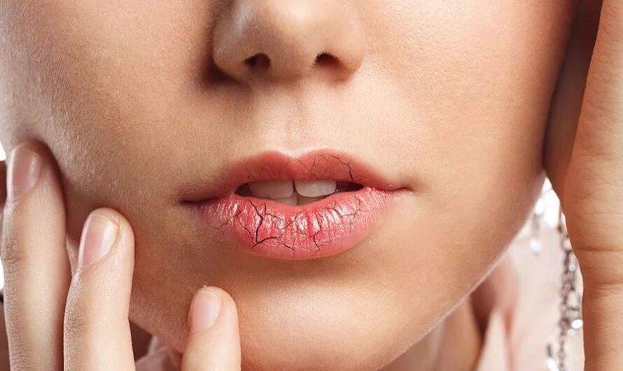 Почему трескаются губы? что делать, если сохнут уголки рта?