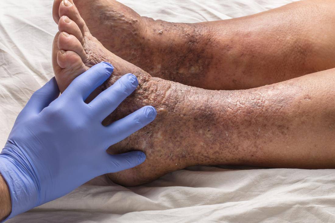 Экзема на ногах - лечение в домашних условиях, причины заболевания, фото