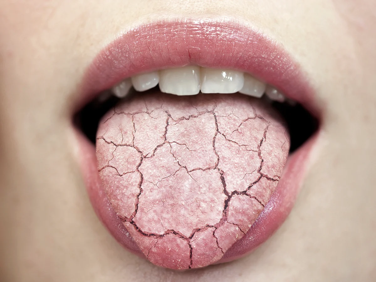Сухость во рту по утрам: причины и лечение, симптомом каких болезней является