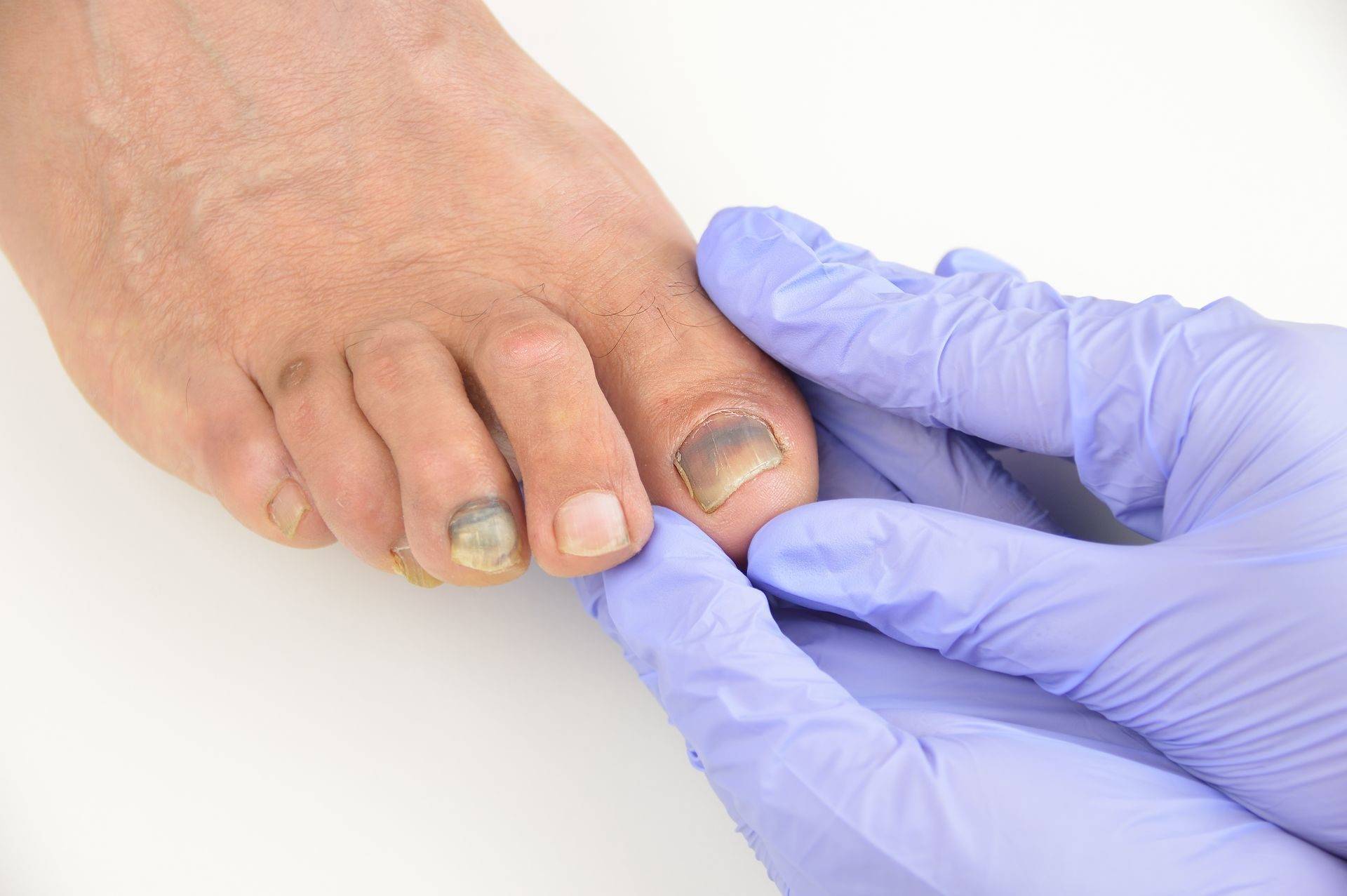 Почему чернеют ногти на ногах у женщин и как лечить