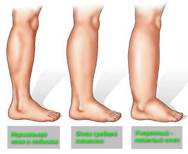 Тянущая боль в ноге от бедра до стопы: чем лечить, почему тянет ногу