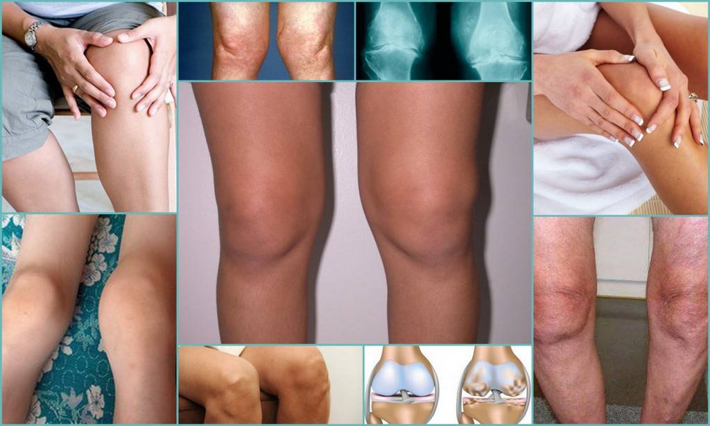 Лечение артроза 2 степени коленного сустава по бубновскому