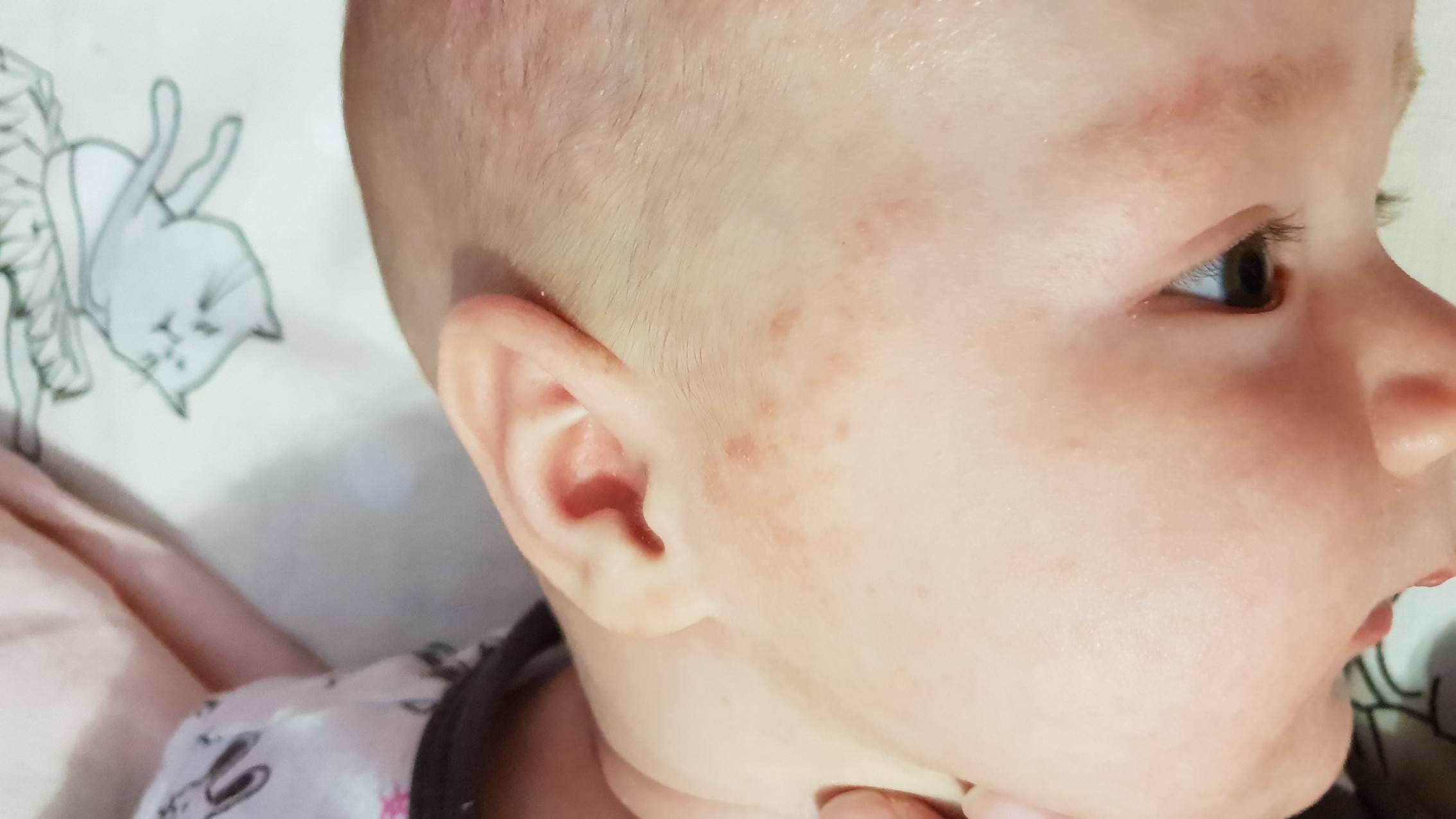 Потничка у новорожденных, грудничков: фото, лечение потницы на лице