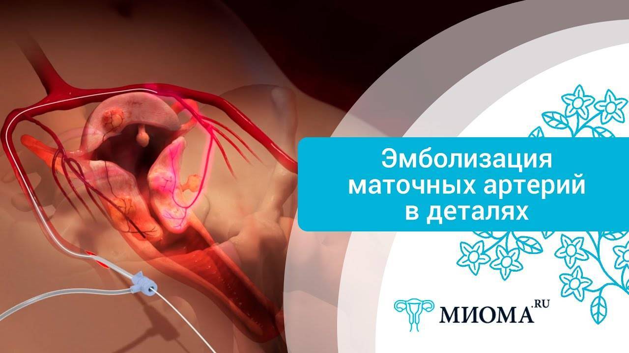 Эмболизация маточных артерий (эма) при миоме матки