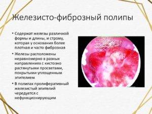 Виды полипов эндометрия: простой, фиброзный, кистозный | компетентно о здоровье на ilive