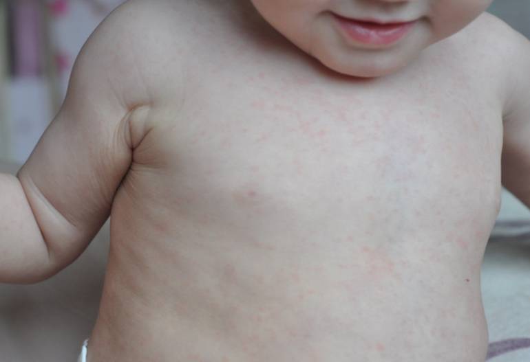 Розеола у детей — что за заболевание и как отличить от аллергии?