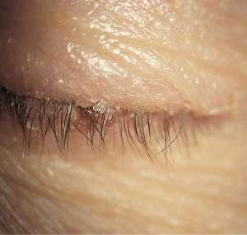 Как лечить демодекс глаз с помощью народной медицины