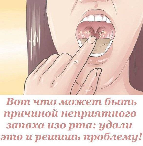 Гниет зуб запах изо рта как избавиться