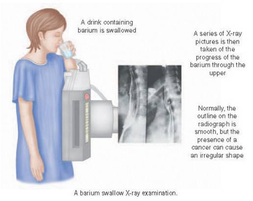 Рентгеноскопия желудка с барием - описание процедуры, что показывает, как делают