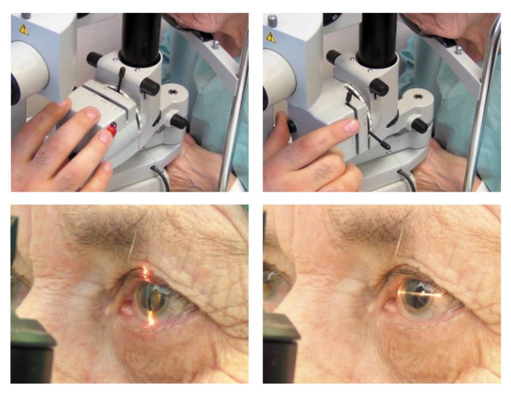 Лечение катаракты без операции