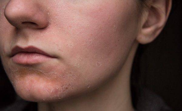 Сухость кожи: симптомы, причины, способы лечения
