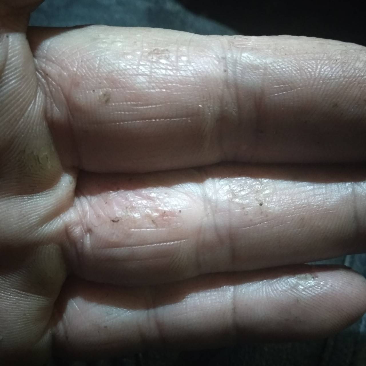 Водянистые прыщи на пальцах рук и ладонях: причины, методы лечения и профилактики