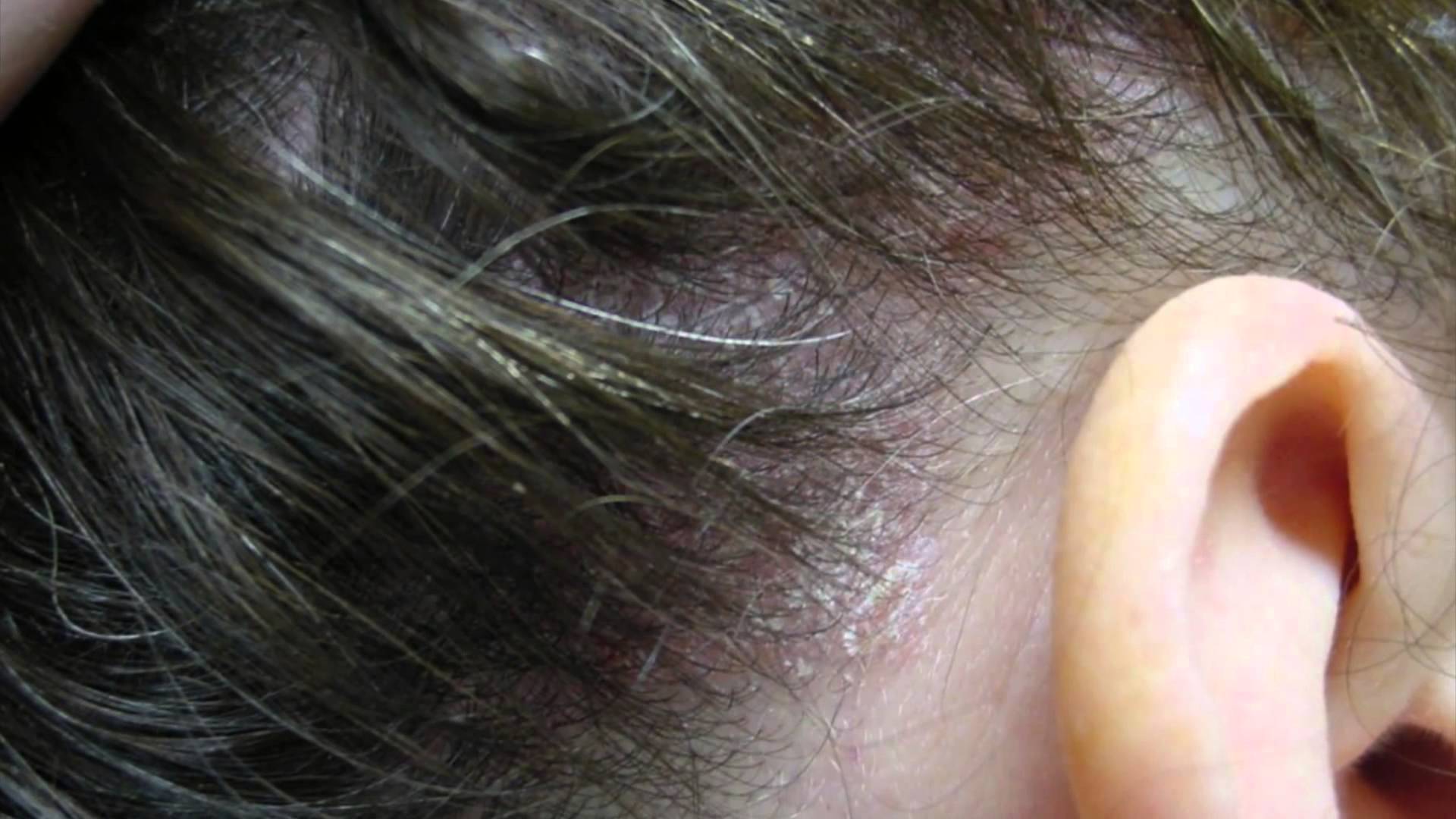 Шелушение в ушах: причины и лечение перхоти и сухости