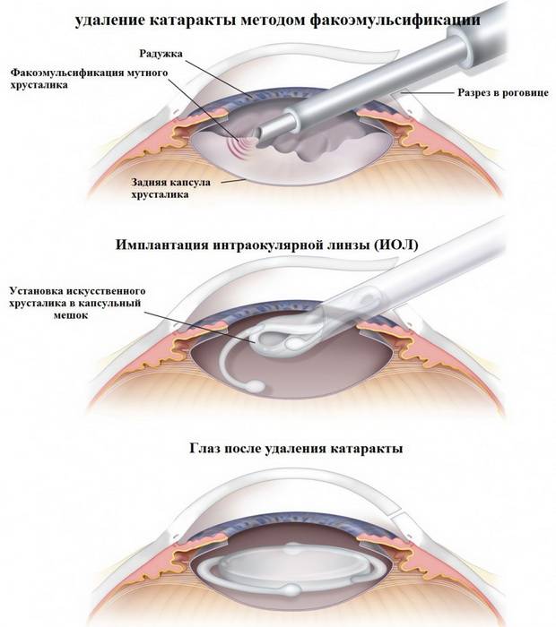 Как лечить катаракту без операции народными средствами