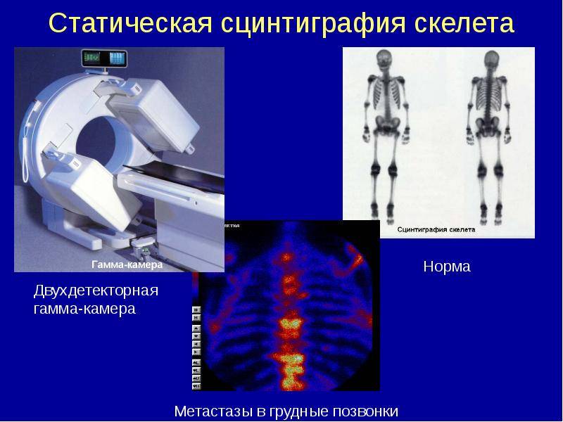 Сцинтиграфия костей скелета (остеосцинтиграфия, сканирование): подготовка, противопоказания, расшифровка результата