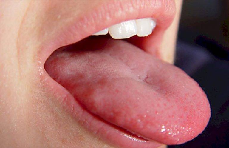 Болит язык у ребенка: симптомы, причины, возможные заболевания, лечение