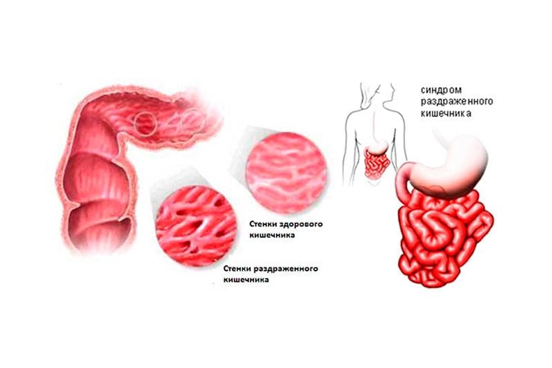 Синдром раздраженного кишечника (срк)