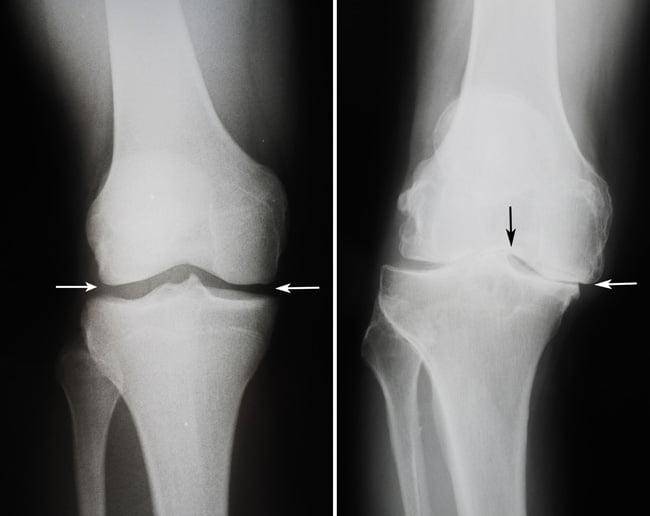 Рентгенологическая картина коленного сустава ребенка