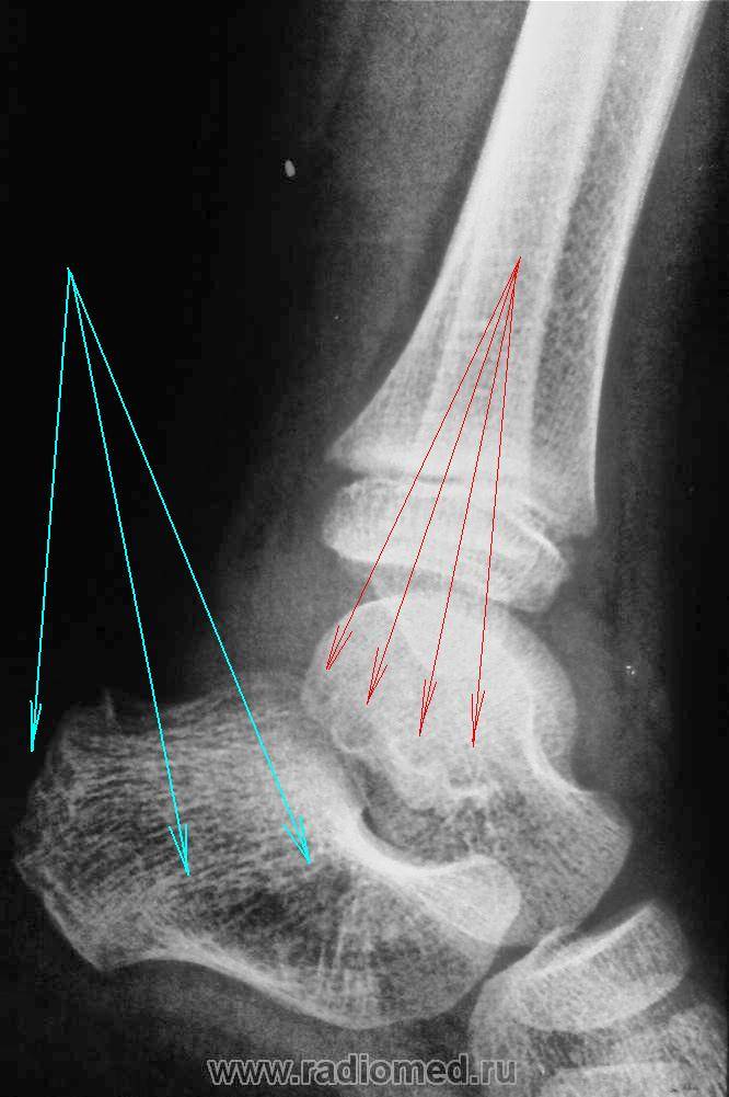 Рентген голени в двух проекциях при переломе и в норме