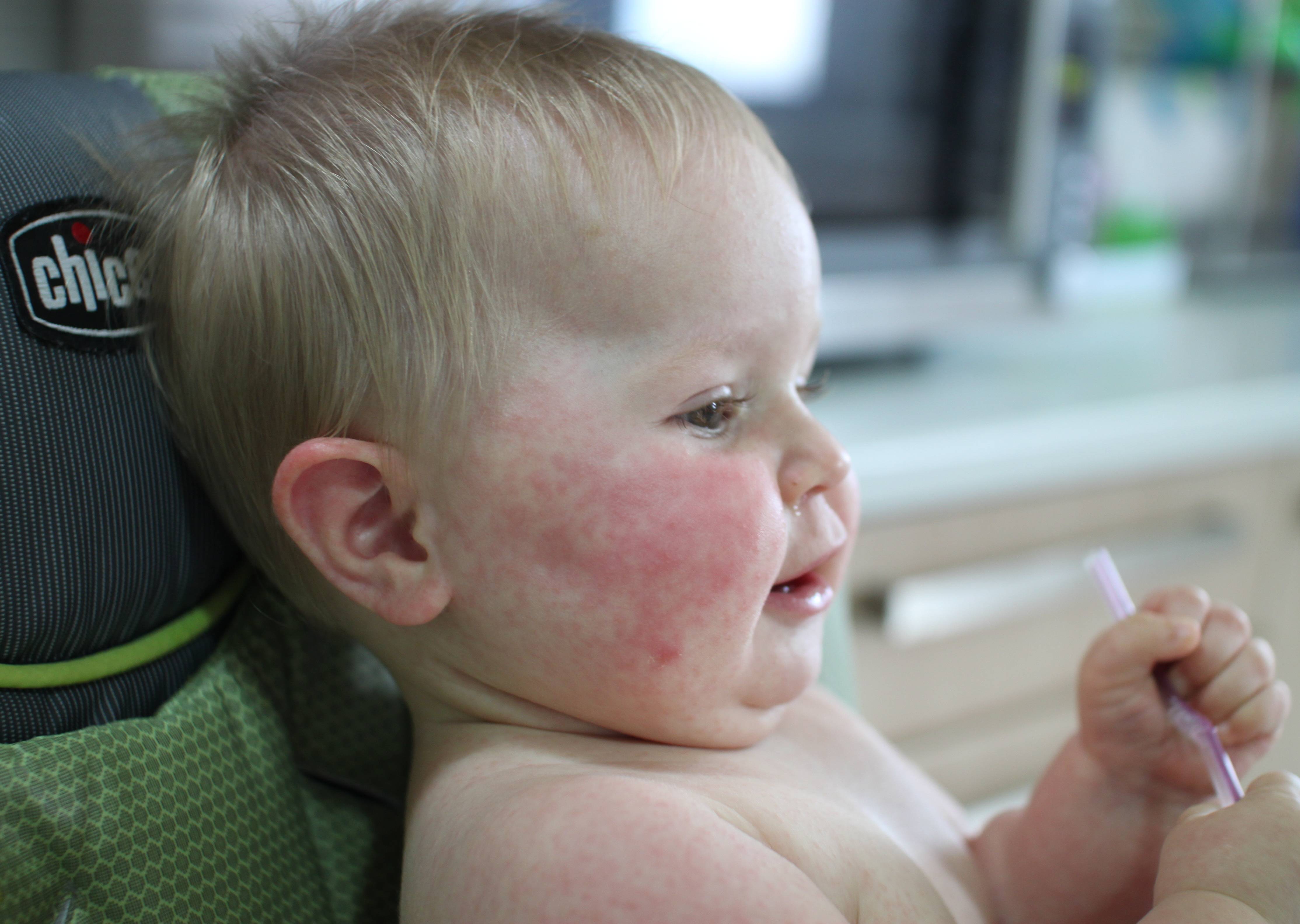 Розеола у детей — что за заболевание и как отличить от аллергии?