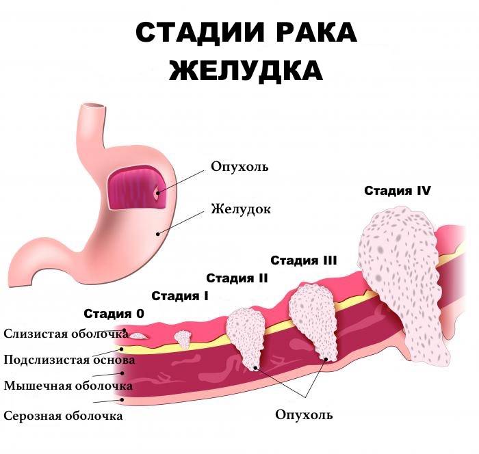 Онкология желудка 4 стадия. Стадии гастрита желудка.