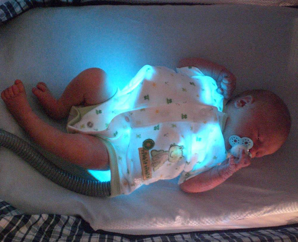 Фототерапия при желтухе у новорожденных | про-гастро