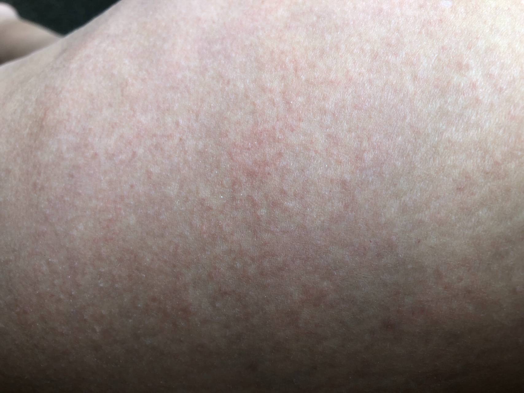 Аллергические высыпания на коже без зуда. причины развития синдрома лайелла. какие продукты могут вызвать аллергию на коже?