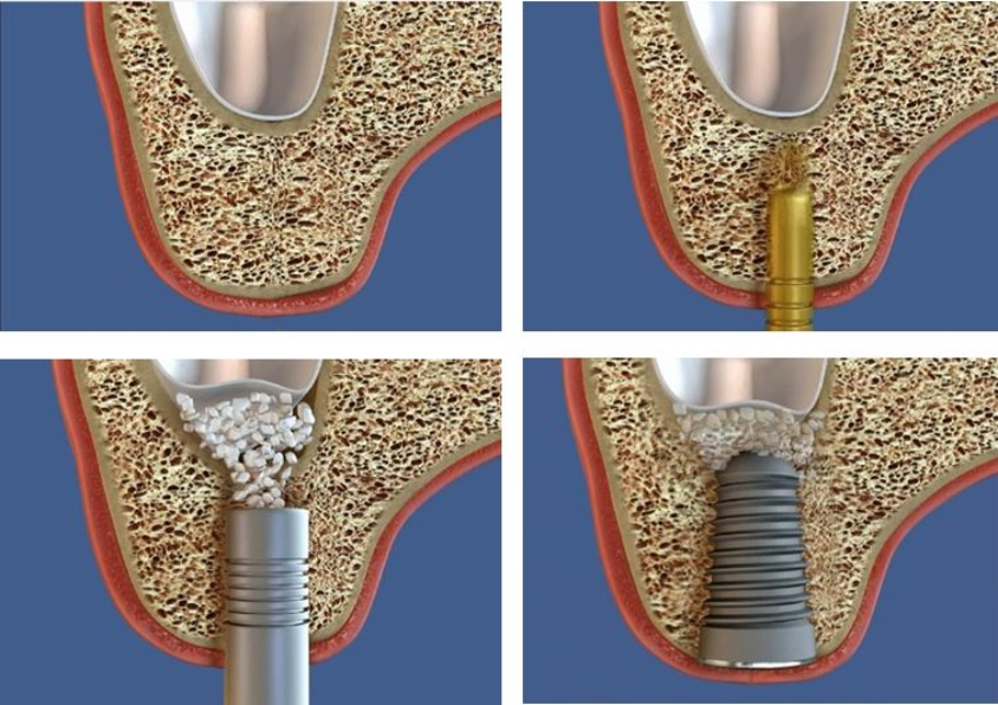 Использование синус-лифтинга при имплантации зубов - фото, отзывы, возможные последствия
