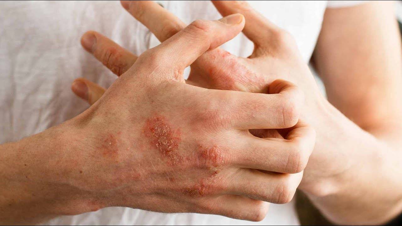 Зуд кожи при аллергии: как снять, таблетки, мази, крема, лечение, фото, симптомы, как убрать