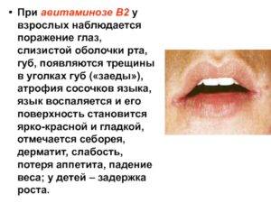 Уголки губ трескаются - причины и лечение в домашних условиях