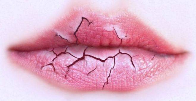 Трещины в уголках губ
